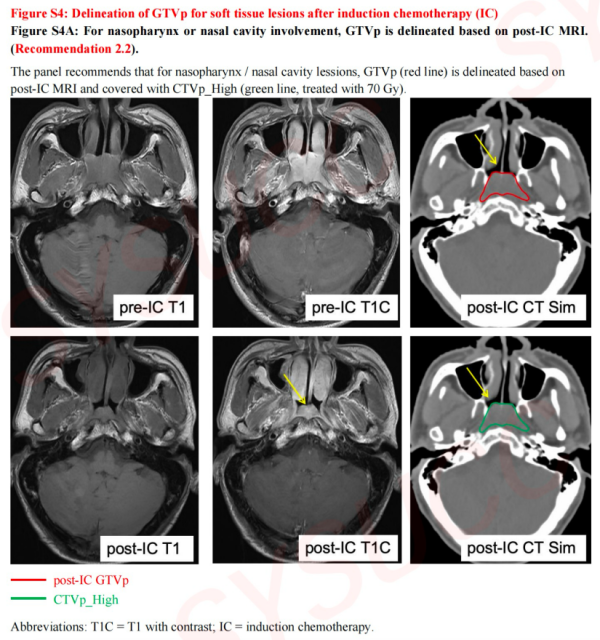 典丰投资 中国学者牵头！鼻咽癌放疗国际指南发布